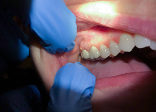 Best Emergency Treatment for Oral Infections in Columbia, IL