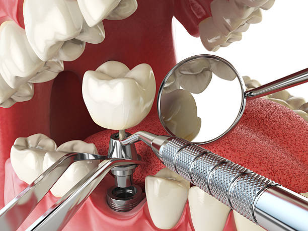 Best Dental Abscess Treatment in Columbia, IL